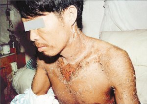 工人受傷圖片 工人受傷圖片